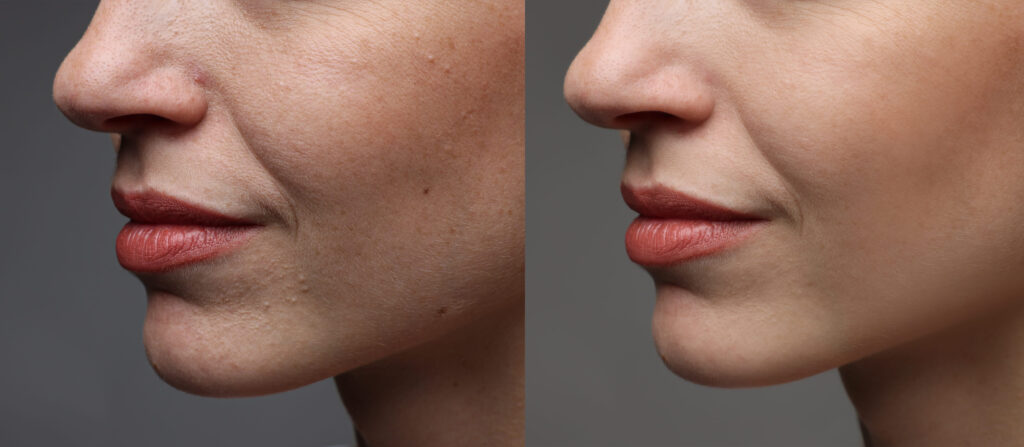 1ml chin filler before and after