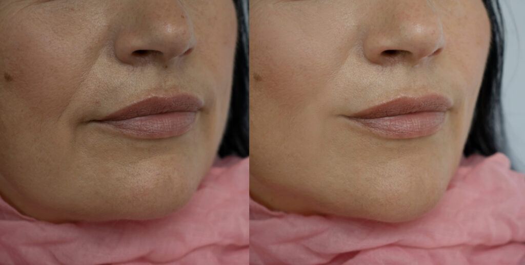 1ml lip filler before and after comparison