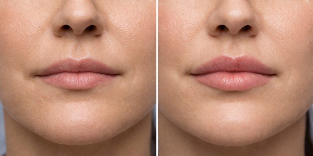 How Much Does a Lip Flip Cost? Botox Lip Flip Price Guide (2026)