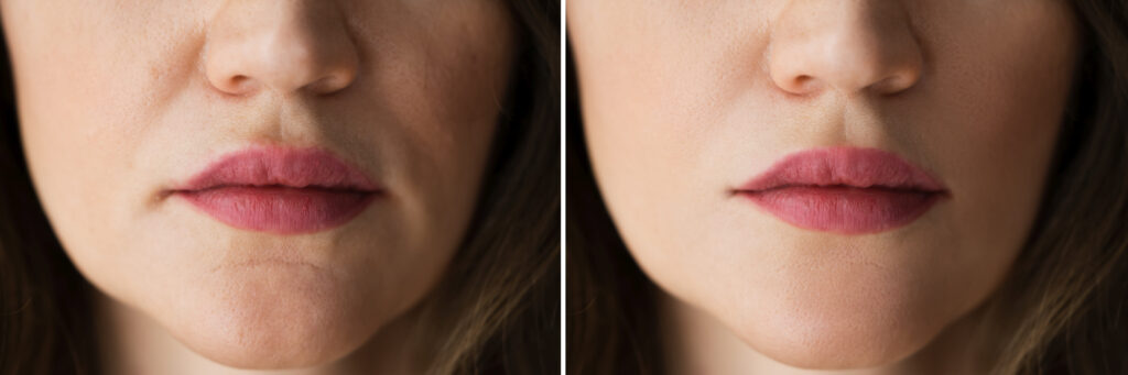 juvederm lip filler before and after natural results one syringe
