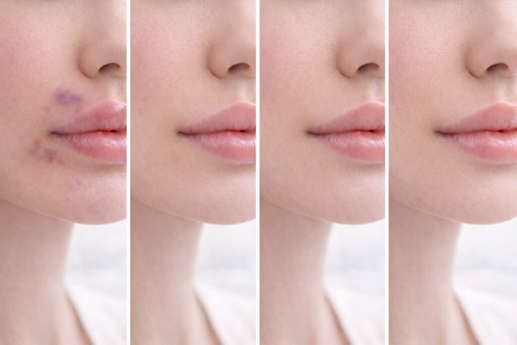 juvederm vs restylane lip filler price per ml comparison