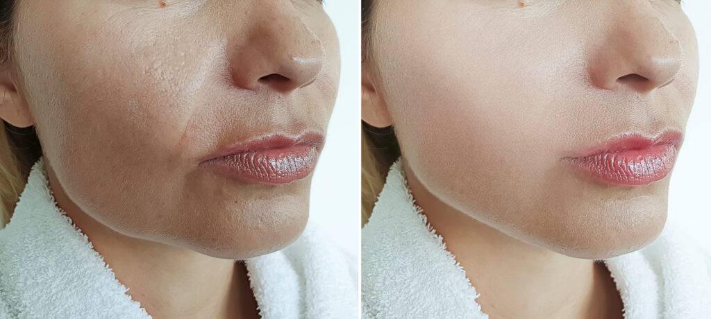 natural lip filler before and after subtle results