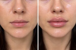 lip filler before and after natural results