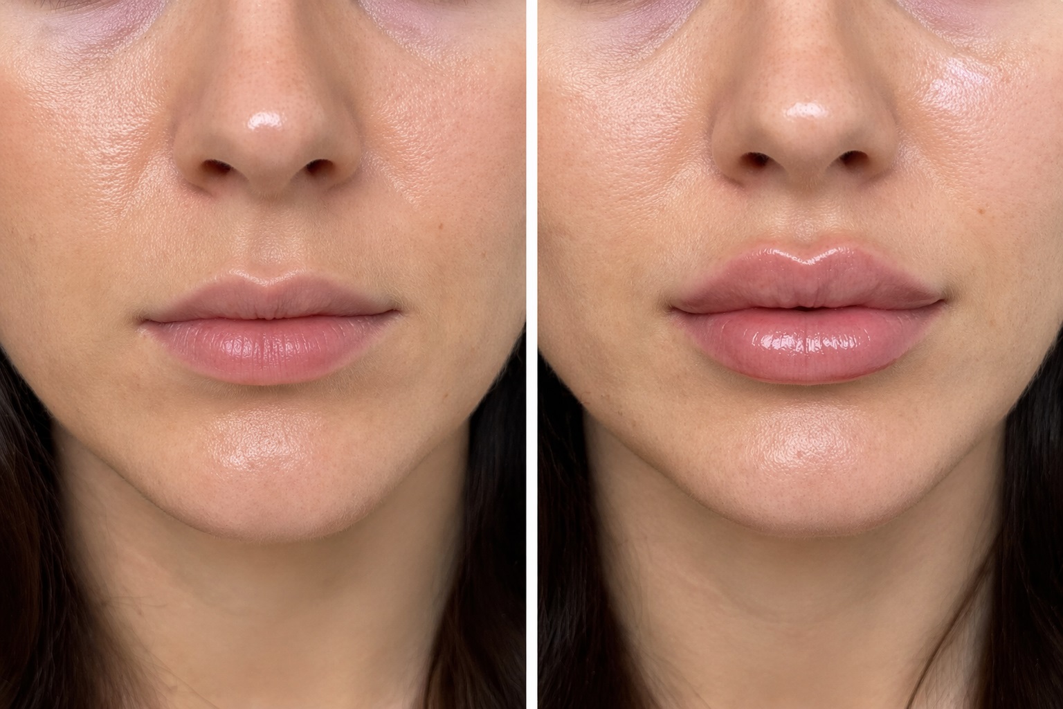 lip filler before and after natural results