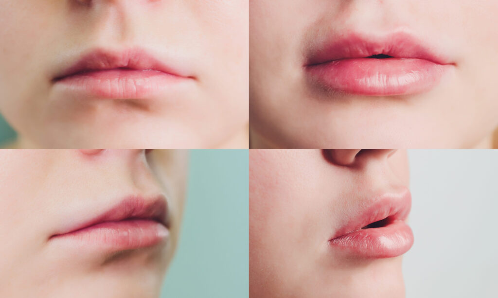 lip filler swelling stages timeline