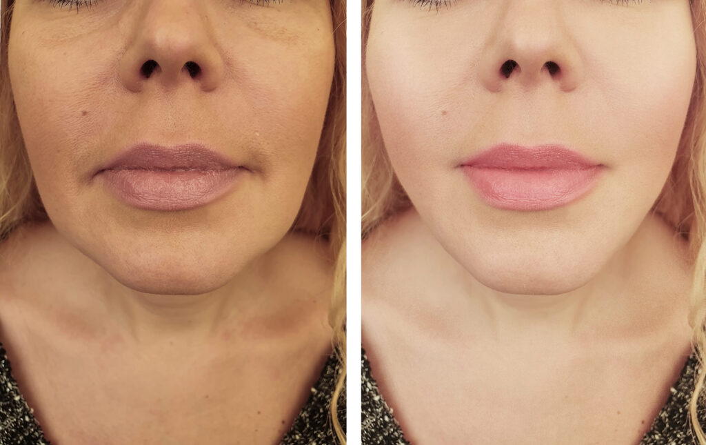 lip filler injections before and after