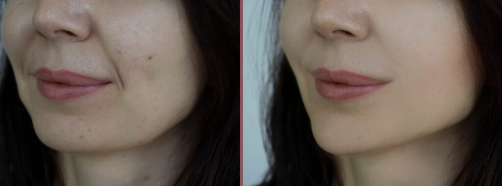lip filler natural vs full results comparison