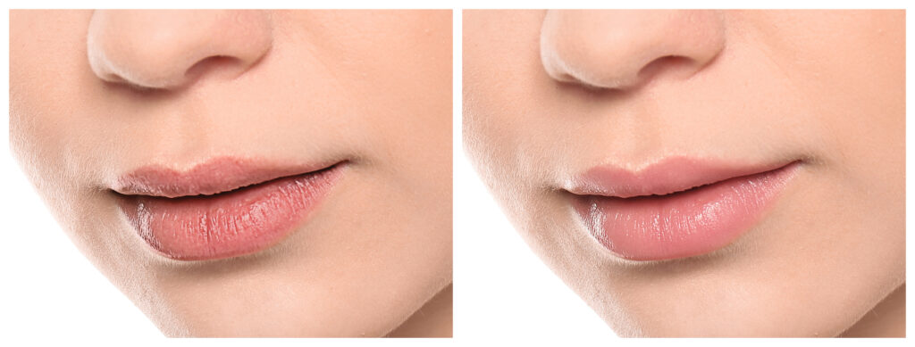 lip filler swelling stages before and after natural results timeline