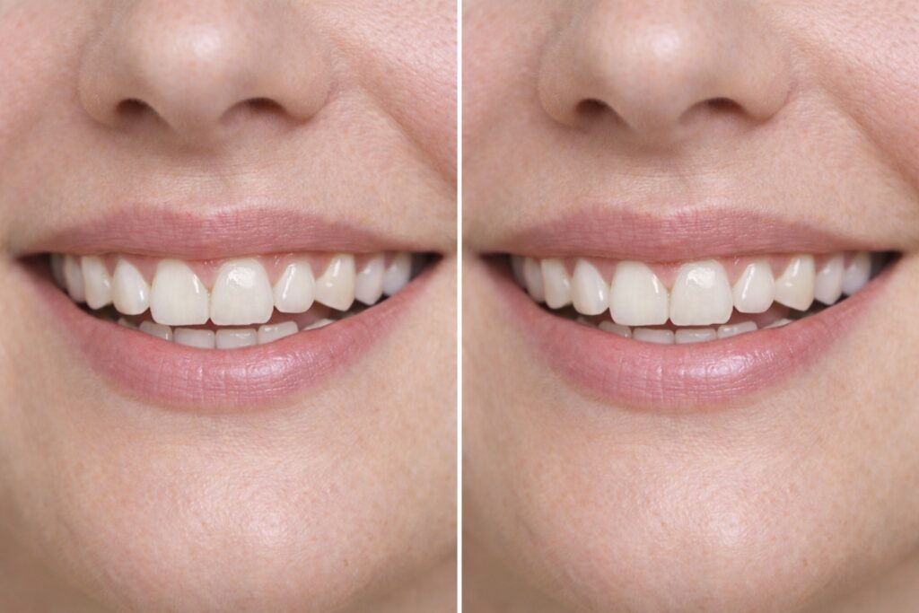 lip flip before and after close up showing upper lip lift and reduced gum visibility