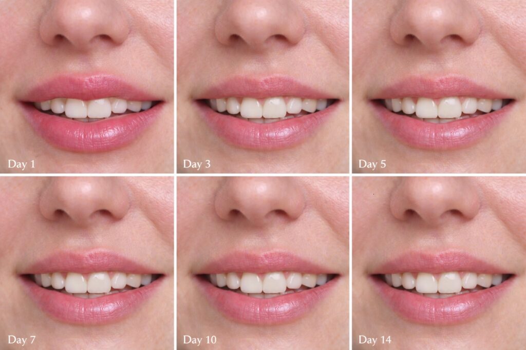 lip flip healing stages day by day showing swelling reduction and natural results progression
