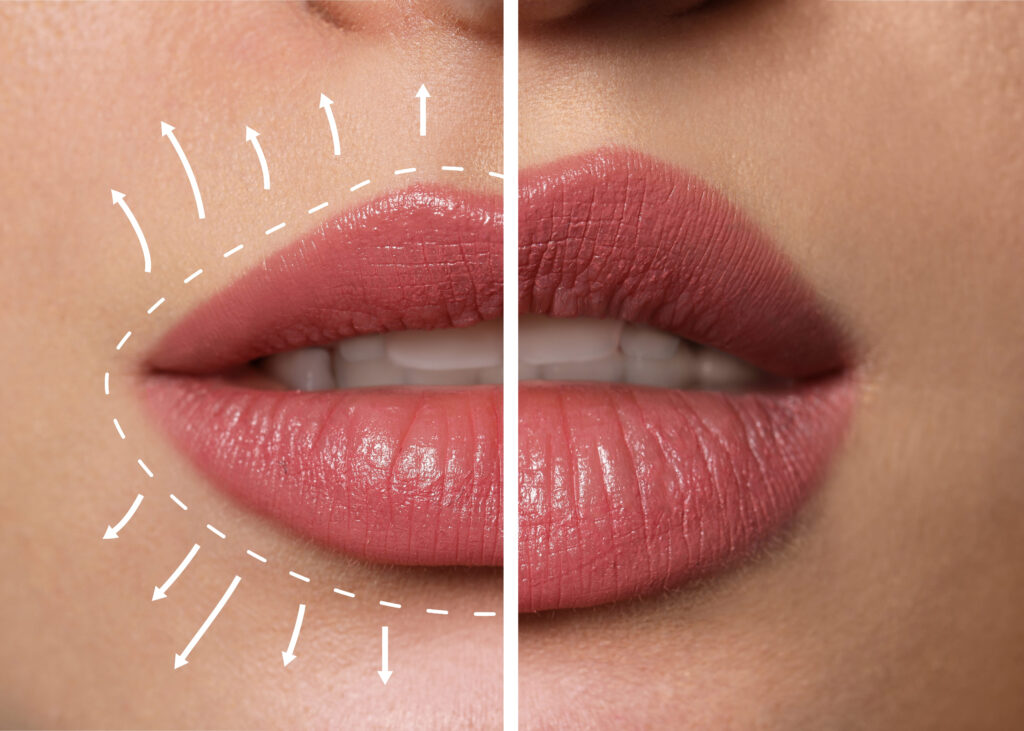 restylane vs juvederm lip filler comparison results