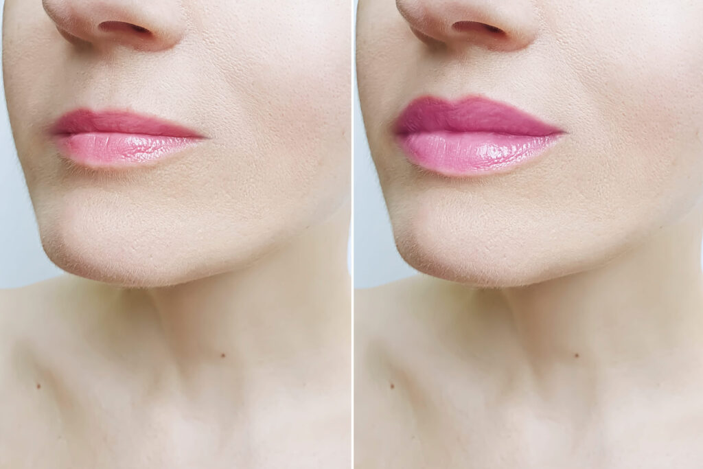 restylane lip filler before and after natural results